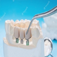 циркониева коронка цена - 68901 новини