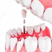 циркониева коронка цена - 32967 варианти