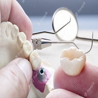 циркониева коронка цена - 97690 отстъпки