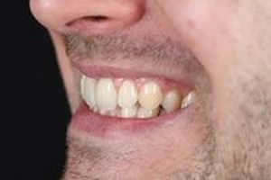 зъбни импланти - 83961 разновидности