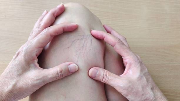 лечение на разширени вени - 99125 бестселъри | medicabilis.eu лечение на разширени вени - 84524 бестселъри